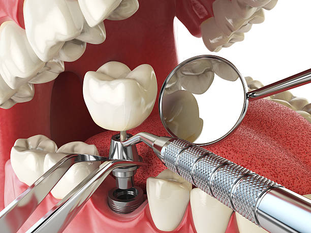 Best Emergency Dental Extractions in Victoria, KS